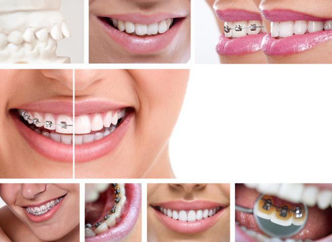 Niềng răng khắc phục mất răng - Nha khoa Việt Đức