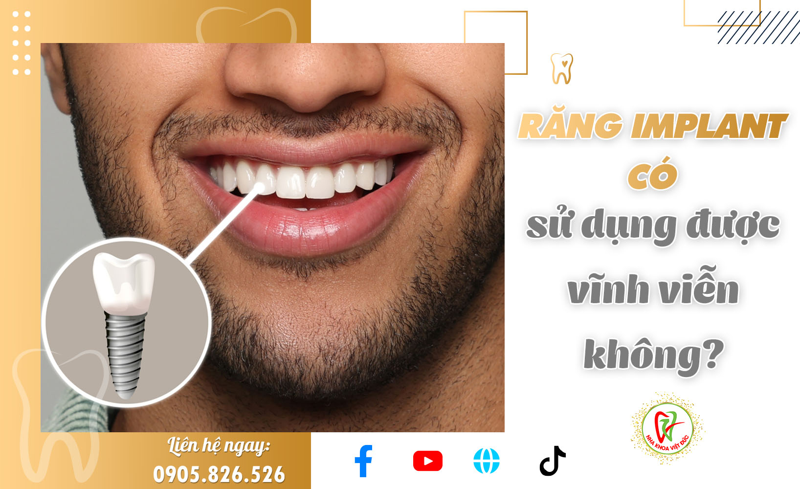 RĂNG IMPLANT CÓ SỬ DỤNG ĐƯỢC VĨNH VIỄN KHÔNG?