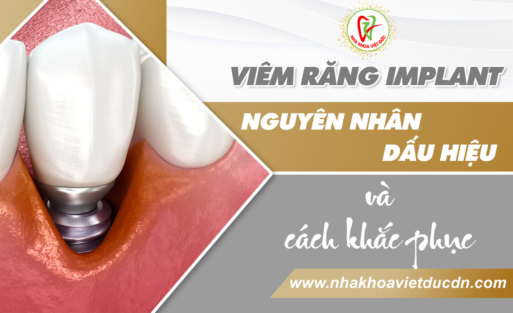 VIÊM RĂNG IMPLANT – NGUYÊN NHÂN, DẤU HIỆU VÀ CÁCH KHẮC PHỤC