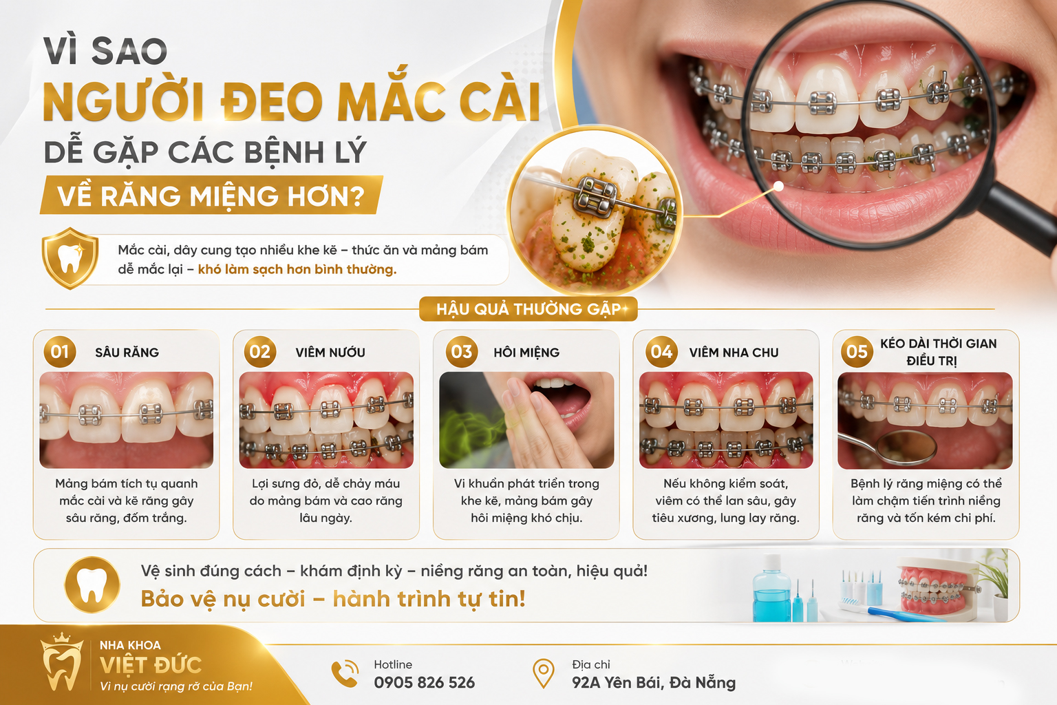 Đốm trắng quanh mắc cài: dấu hiệu gì và cách giảm nguy cơ?